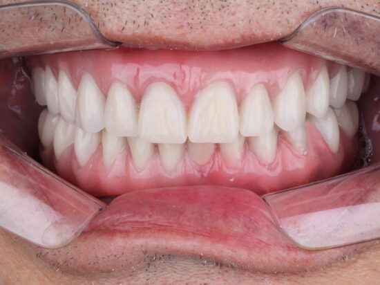 Rehabilitación total con prótesis tipo protocolarias superior e inferior con dientes Delara